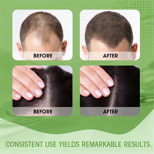 Hair Regrowth System - Hair Growth Treatment with