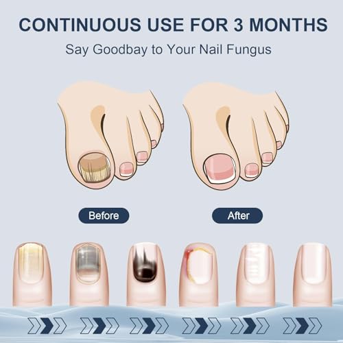 CENYEDA Dispositivo de limpieza de hongos en las u