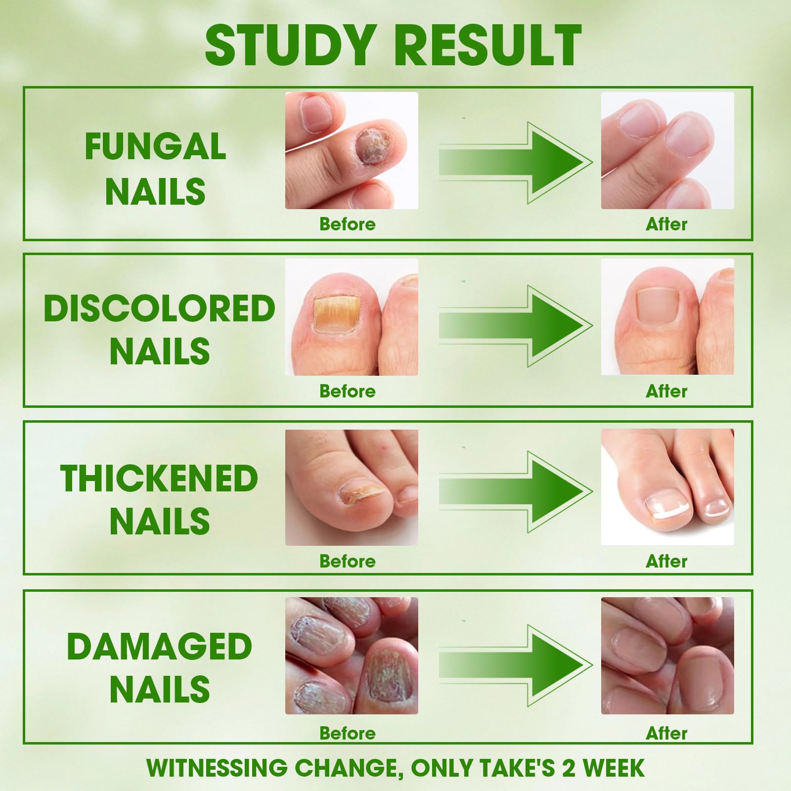 Toenail Fungus Kit – 4-Step Treatment with Cleansing & Care